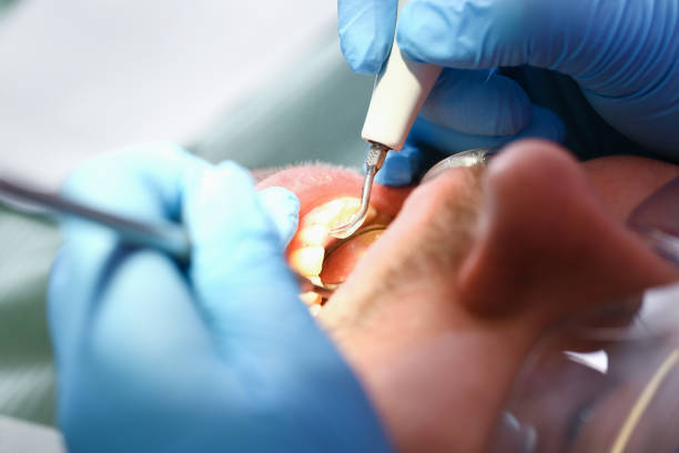 Best Chipped Tooth Repair Near Me  in Rosemead, CA